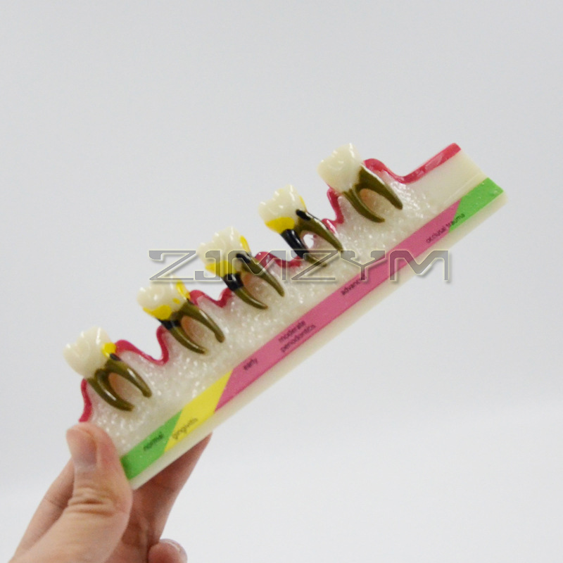 Periodontal Disease Model Dent - Medical Lab Study review and price